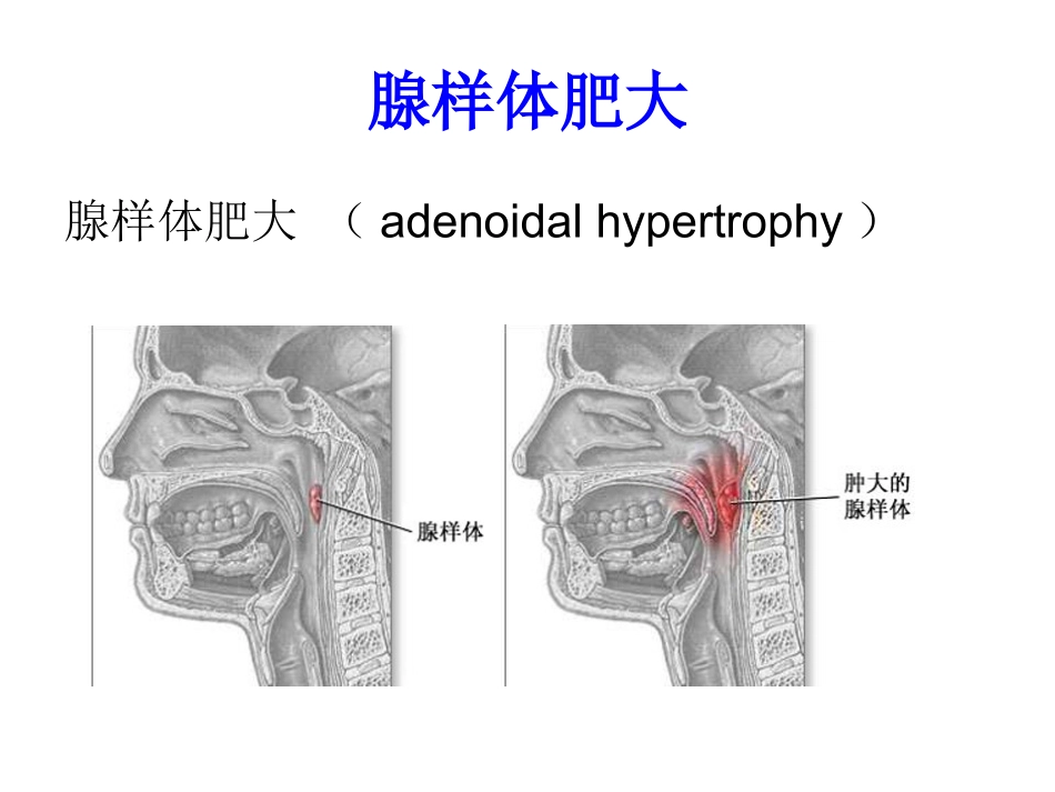 6)腺样体炎、咽及颌面脓肿、喉解剖、急慢性喉炎、声带息肉、急性会厌炎 .ppt_第2页