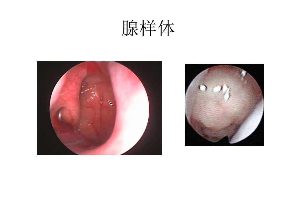 6)腺样体炎、咽及颌面脓肿、喉解剖、急慢性喉炎、声带息肉、急性会厌炎 .ppt_第3页