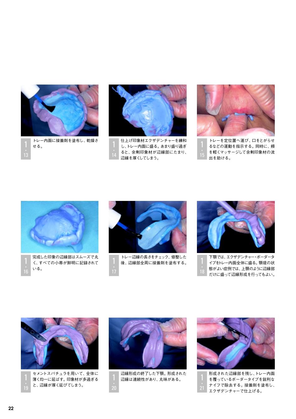 采用硅橡胶印模材料的简便的无牙颌功能印模.pdf_第3页