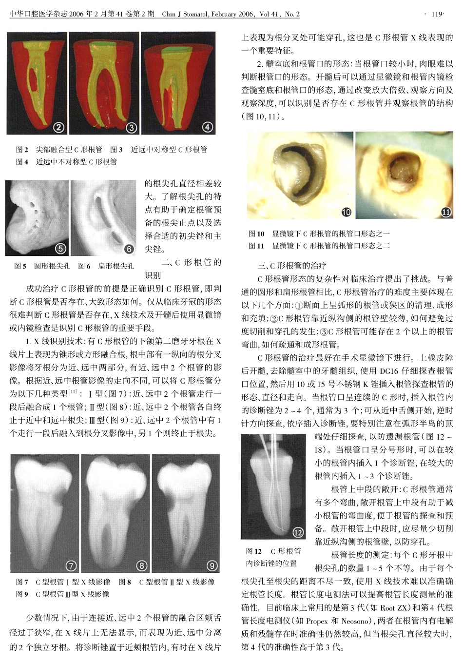 牙体牙髓临床治疗Ⅰ.C形根管的形态、识别和治疗.pdf_第2页