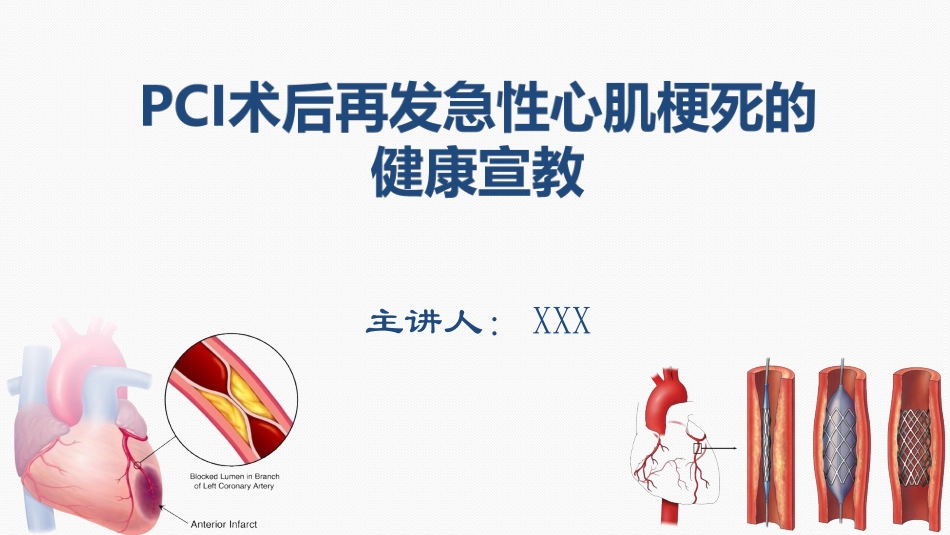 PCI术后再发急性心肌梗死的健康宣教.ppt_第1页