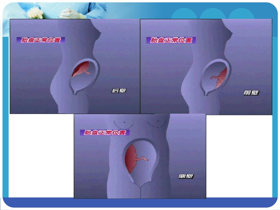 2025年医学资料：5)前置胎盘 新版.ppt_第3页