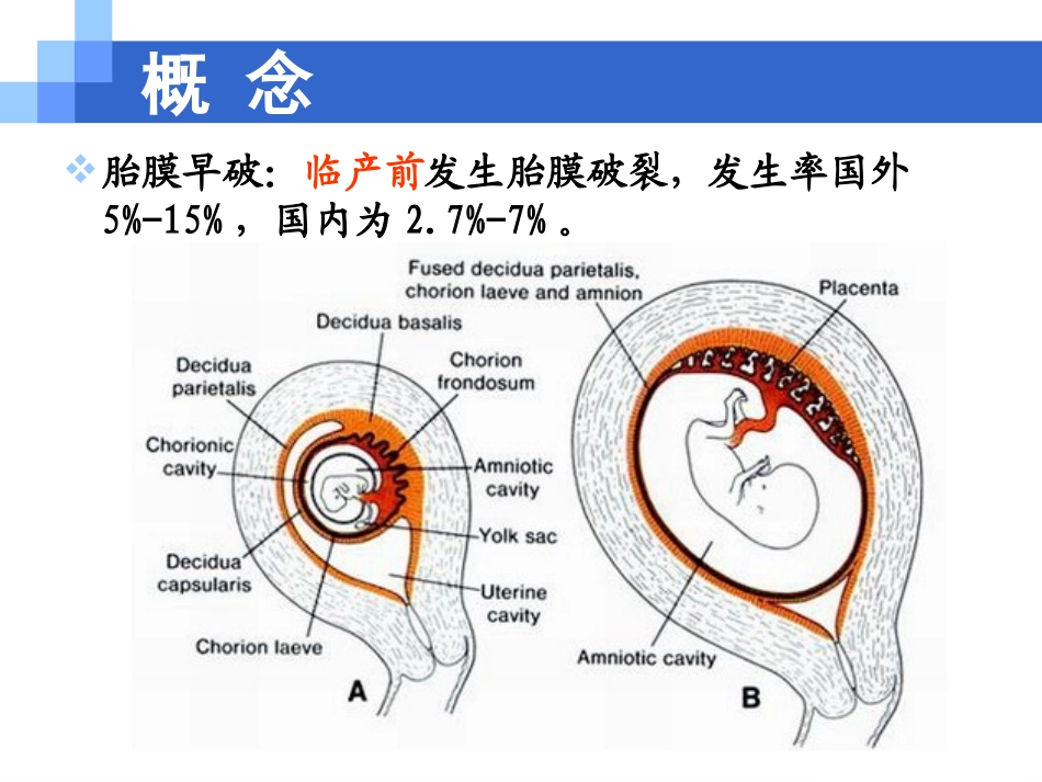 2025年医学资料：8)胎膜早破.ppt_第2页