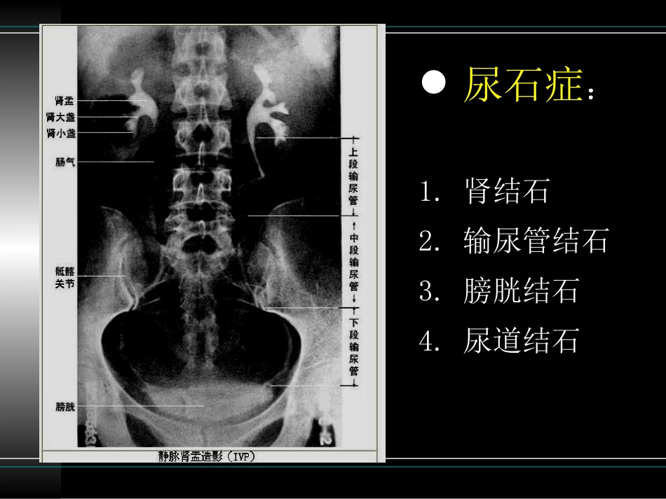 2025年医学资料：32)尿   石    症.ppt_第2页