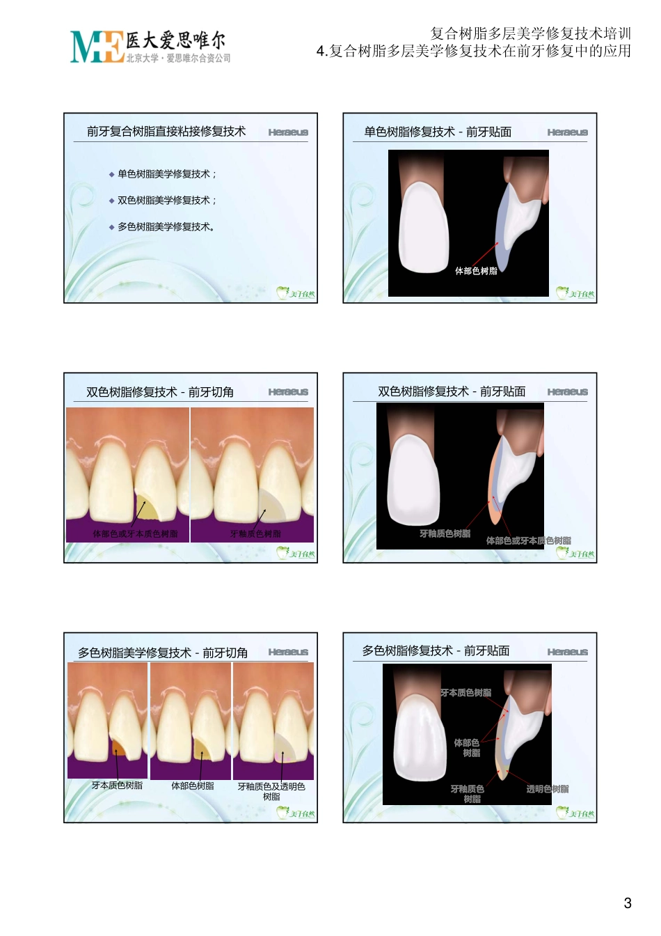 2025年医学资料：4.复合树脂多层美学修复技术在前牙修复中的应用.PDF_第3页