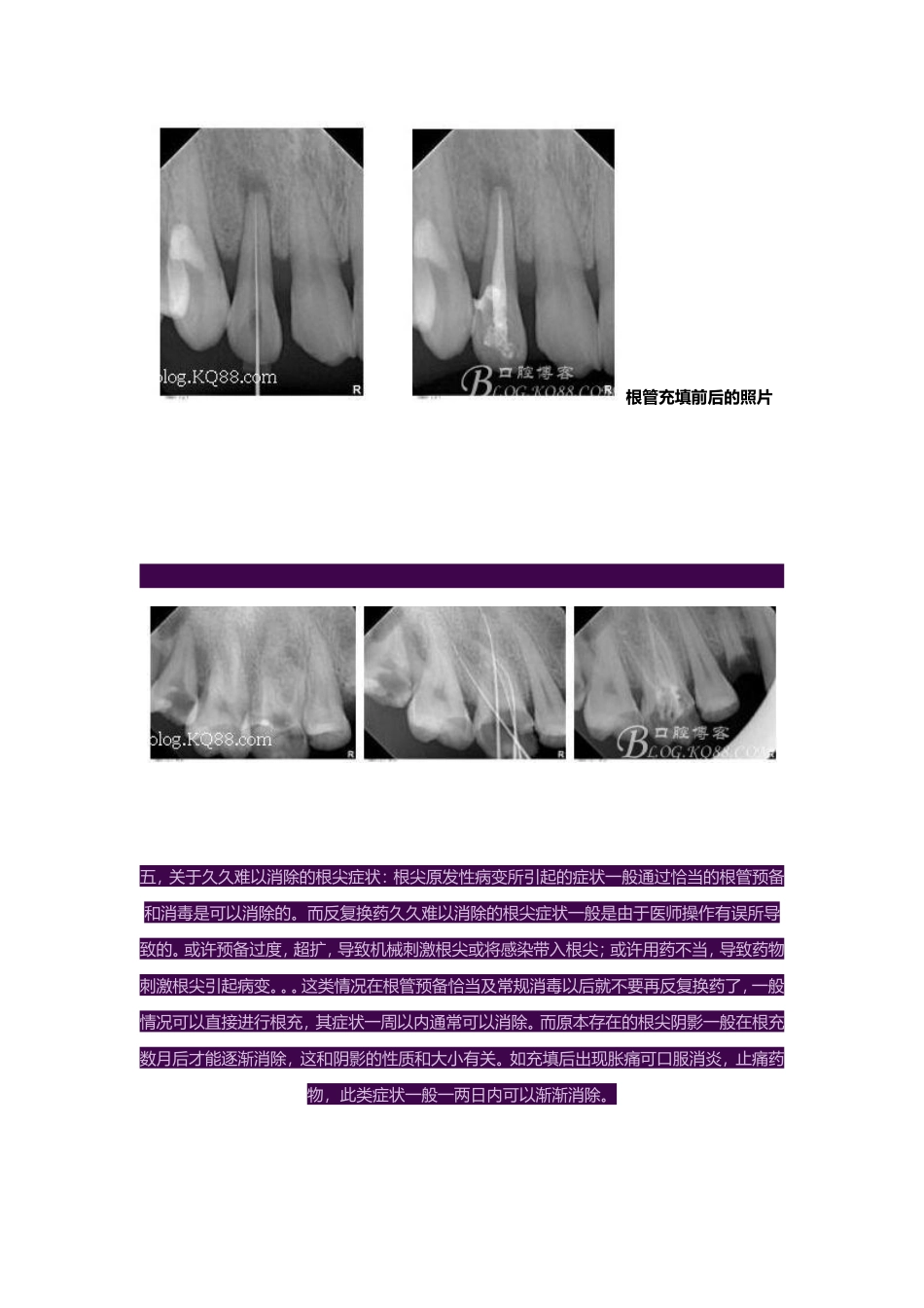 2025年医学资料：根管治疗要领.doc_第3页