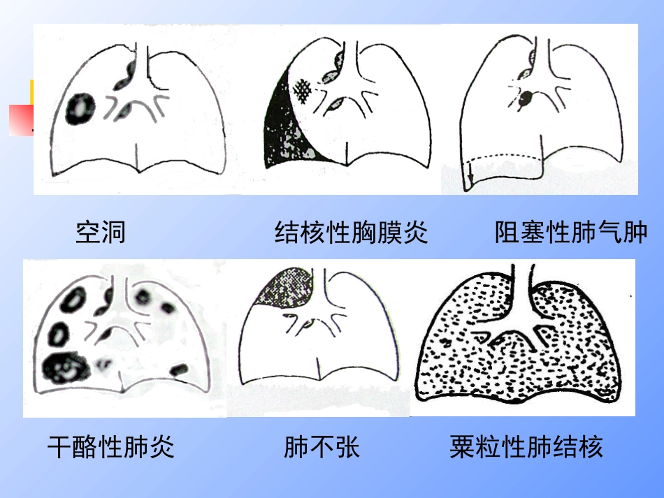 2025年慢性病知识讲座：抗结核治疗.ppt_第2页