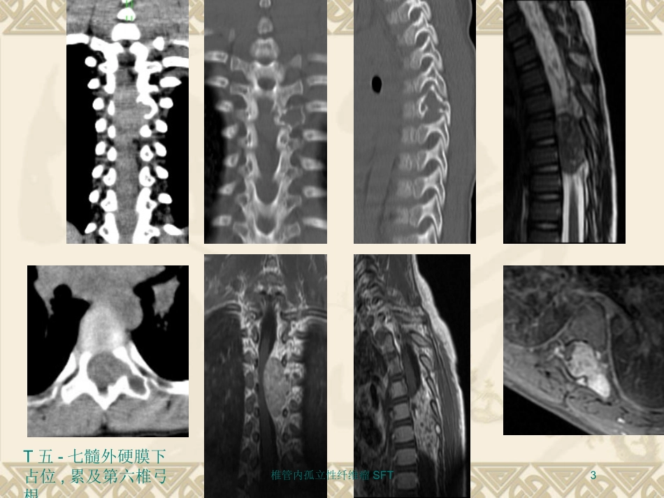 椎管内孤立性纤维瘤SFT培训课件.pptx_第3页
