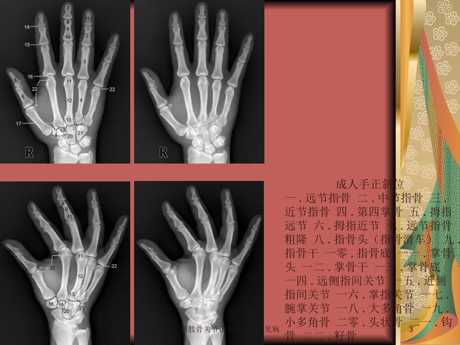 四肢骨关节正常变异与常见病培训课件.pptx_第3页