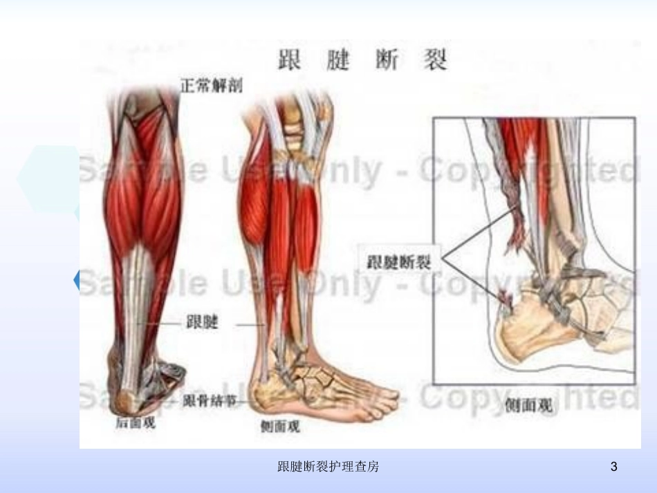 跟腱断裂护理查房培训课件.pptx_第3页
