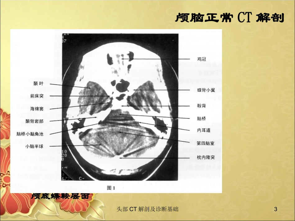头部CT解剖及诊断基础培训课件.pptx_第3页