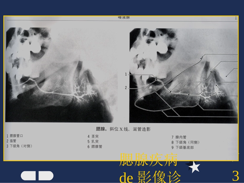 腮腺疾病的影像诊断培训课件.pptx_第3页