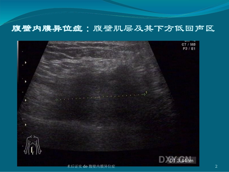 术后证实的腹壁内膜异位症培训课件.pptx_第2页