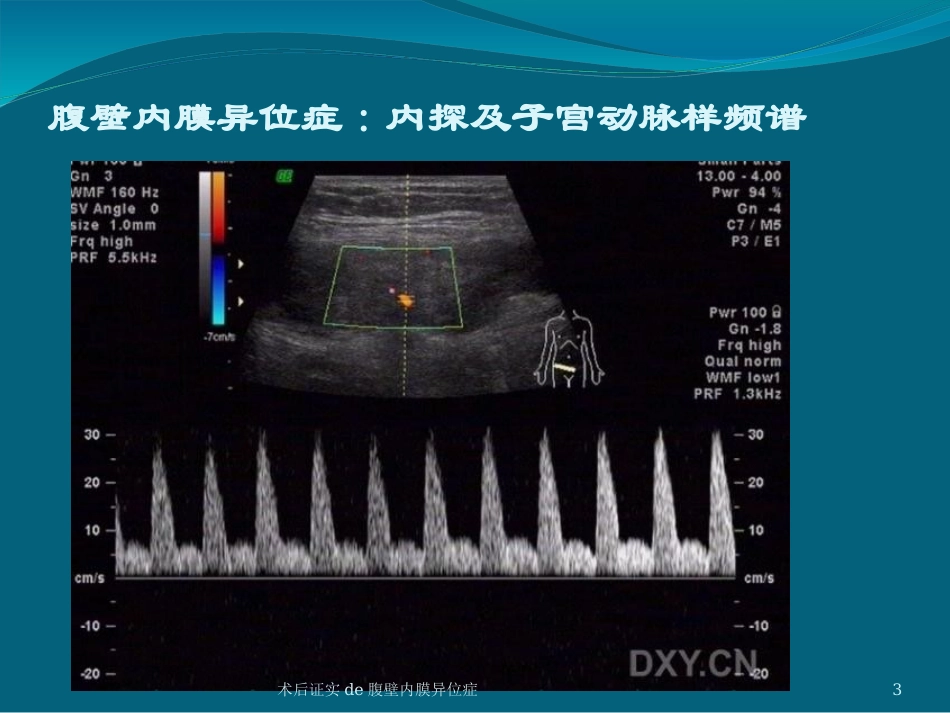 术后证实的腹壁内膜异位症培训课件.pptx_第3页