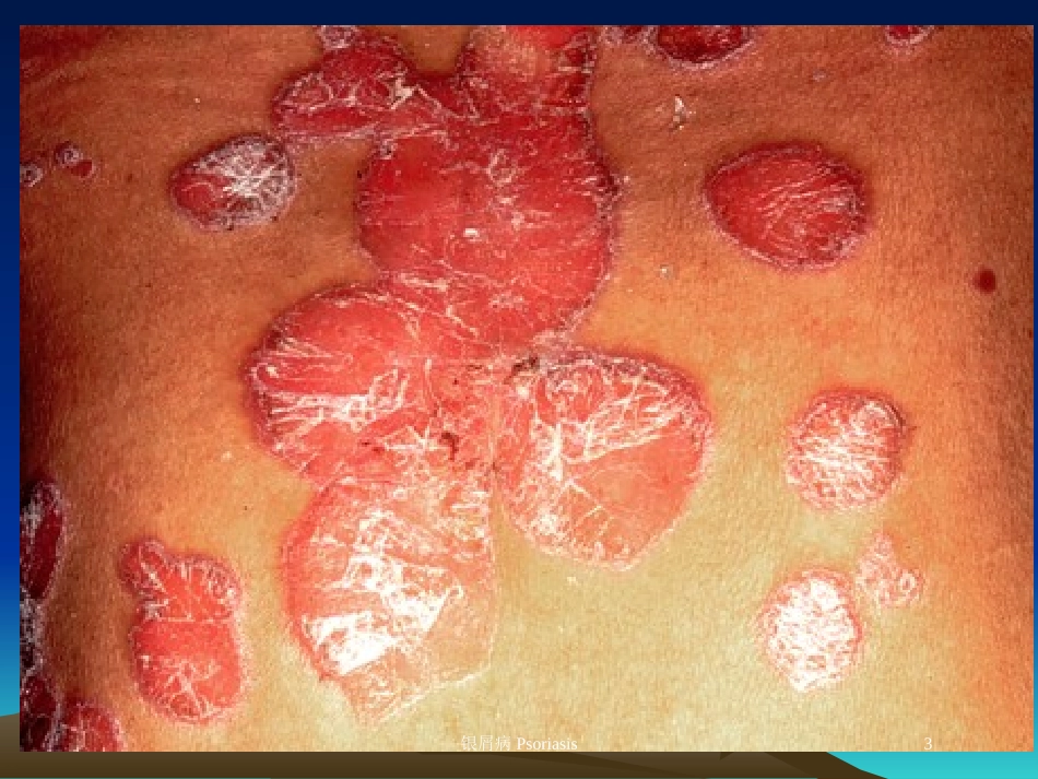 银屑病Psoriasis培训课件.pptx_第3页