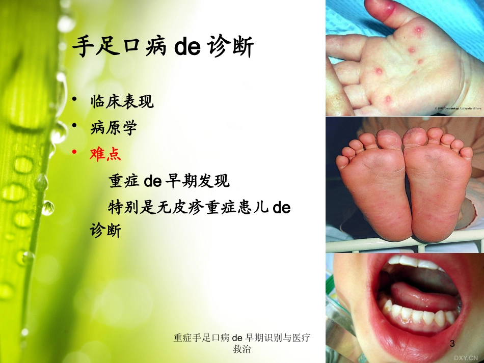 重症手足口病的早期识别与医疗救治培训课件.pptx_第3页
