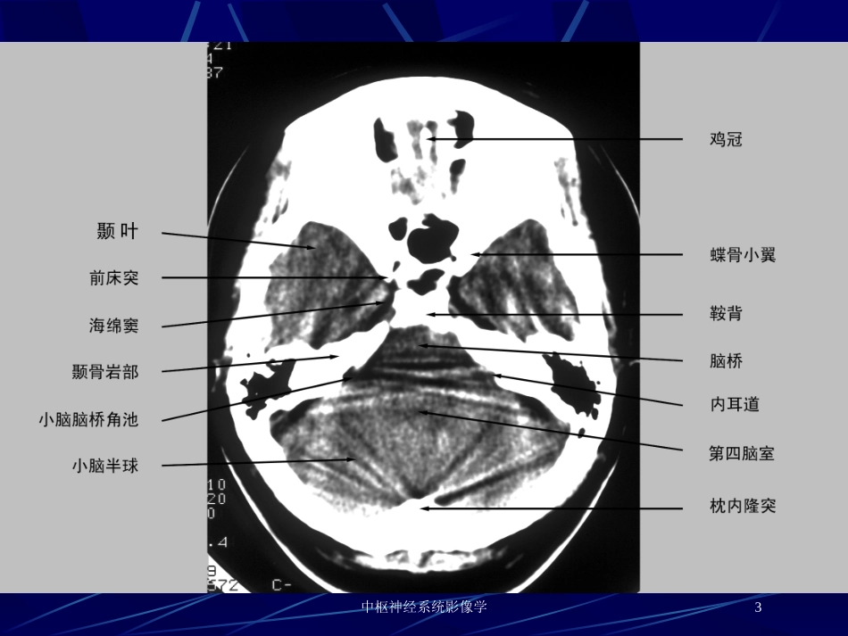 中枢神经系统影像学培训课件.pptx_第3页