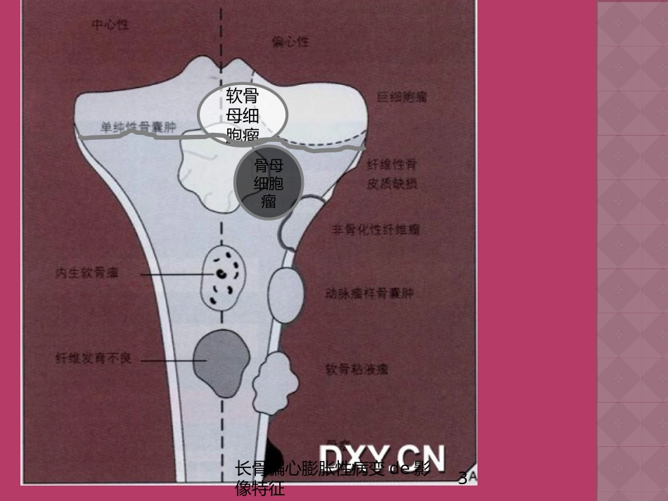 长骨偏心膨胀性病变的影像特征培训课件.pptx_第3页