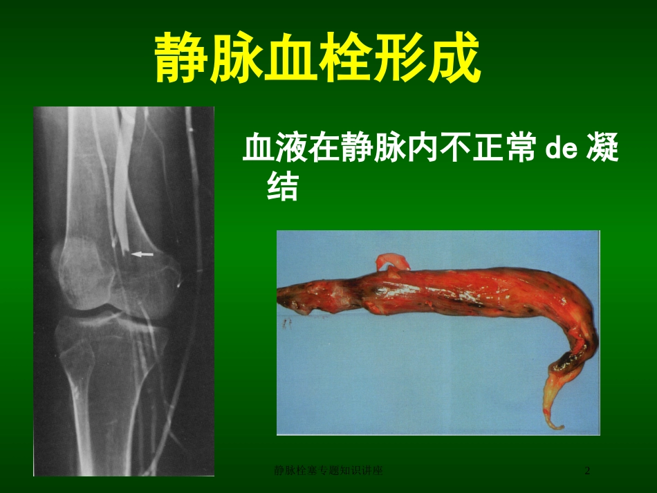 静脉栓塞专题知识讲座培训课件.pptx_第2页