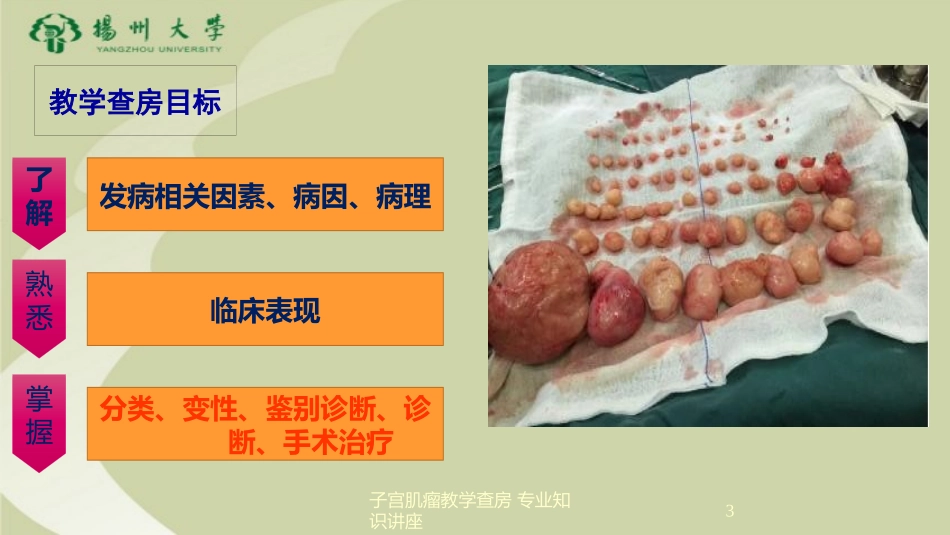 子宫肌瘤教学查房-专业知识讲座培训课件.pptx_第3页
