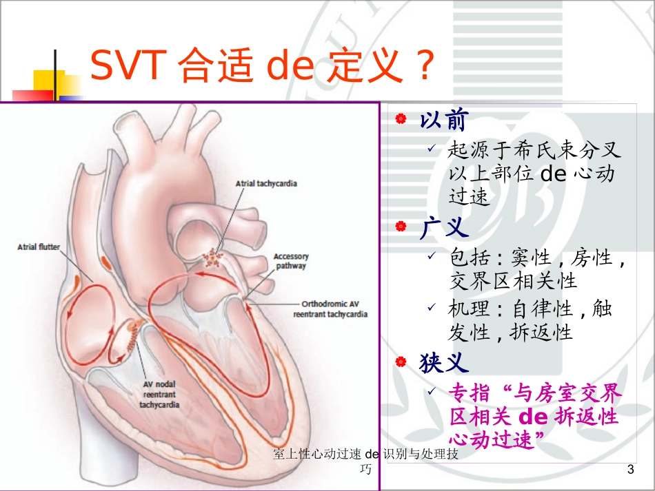 室上性心动过速的识别与处理技巧培训课件.pptx_第3页