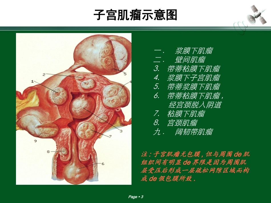 子宫肌瘤的超声诊断培训课件.pptx_第3页