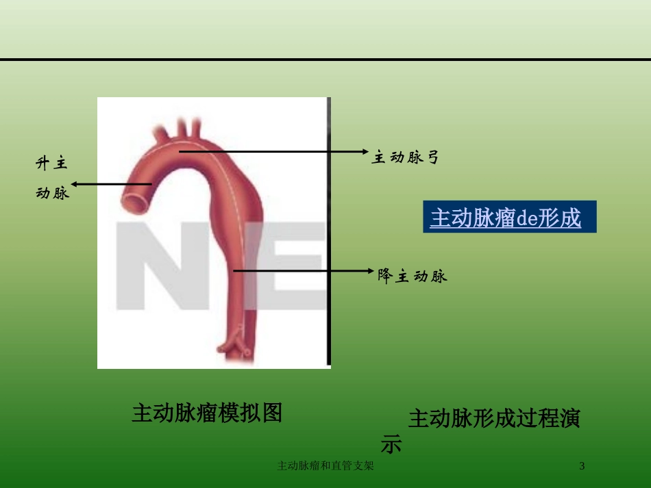 主动脉瘤和直管支架培训课件.pptx_第3页