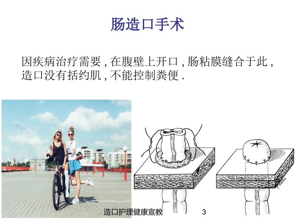 造口护理健康宣教培训课件.pptx_第3页