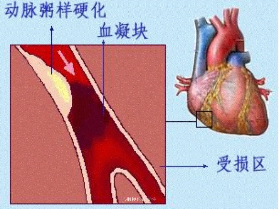 心肌梗死的防治培训课件.pptx_第3页