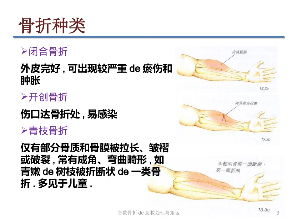 急救骨折的急救处理与搬运培训课件.pptx_第3页