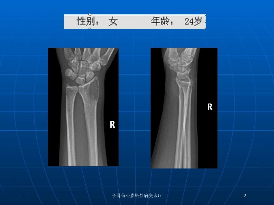 长骨偏心膨胀性病变诊疗培训课件.pptx_第2页