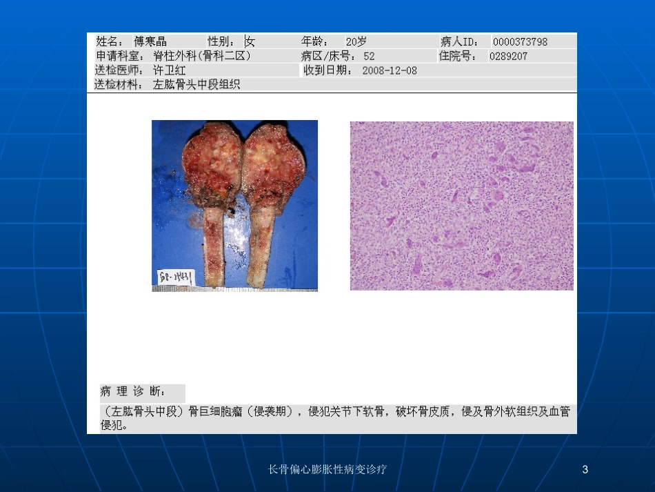 长骨偏心膨胀性病变诊疗培训课件.pptx_第3页