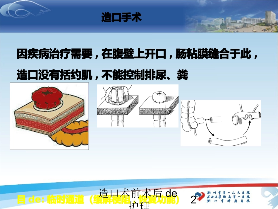 造口术前术后的护理培训课件.pptx_第2页