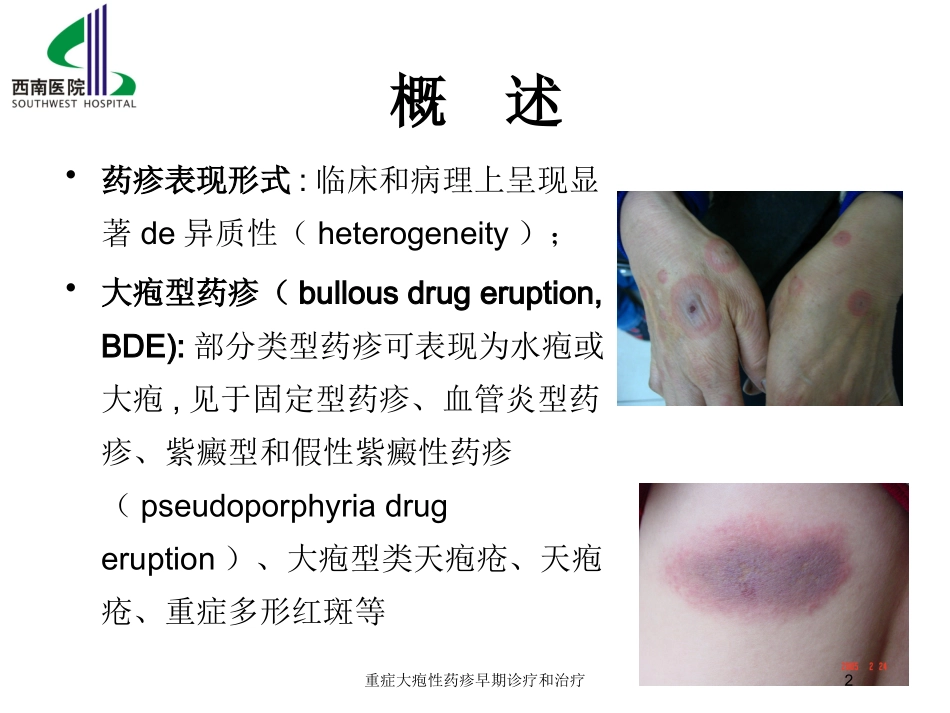 重症大疱性药疹早期诊疗和治疗培训课件.pptx_第2页