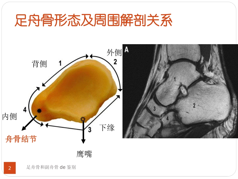 足舟骨和副舟骨的鉴别培训课件.pptx_第2页