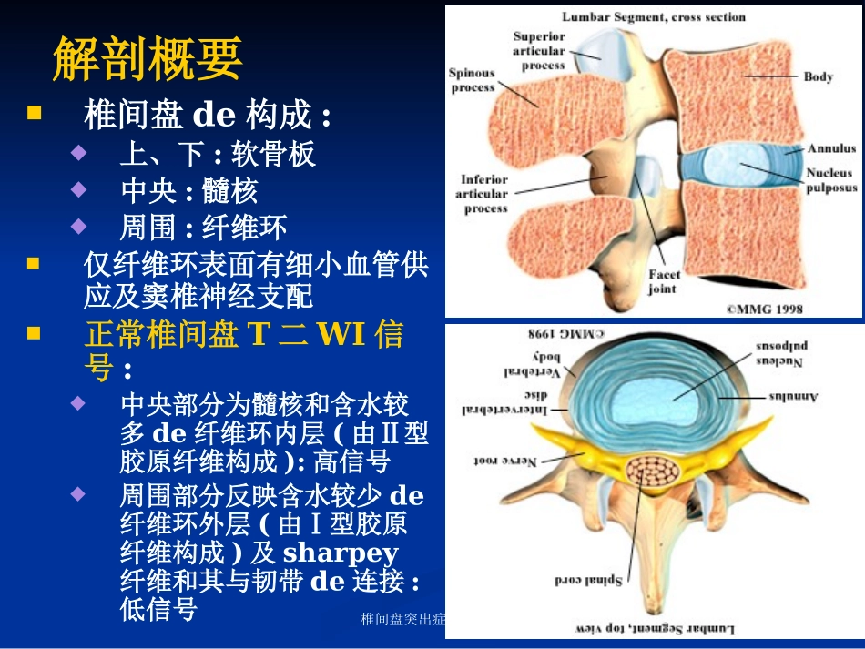 椎间盘突出症影像诊疗培训课件.pptx_第2页