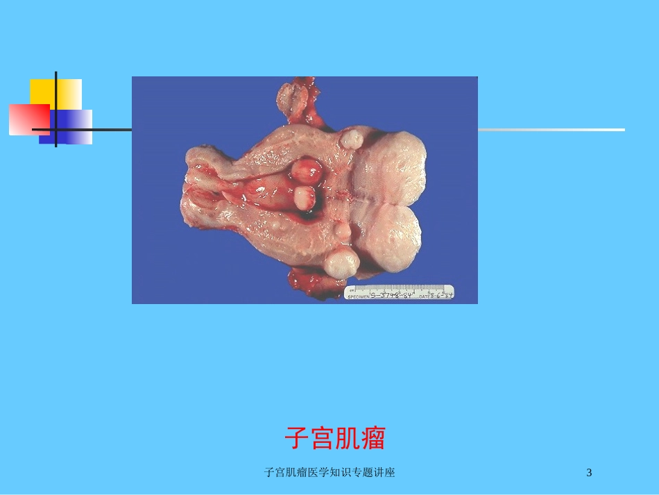 子宫肌瘤医学知识专题讲座培训课件.pptx_第3页