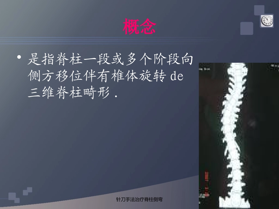 针刀手法治疗脊柱侧弯培训课件.pptx_第3页