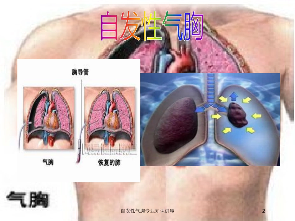 自发性气胸专业知识讲座培训课件.pptx_第2页