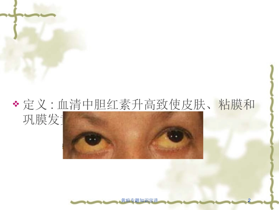 黄疸专题知识宣讲培训课件.pptx_第2页