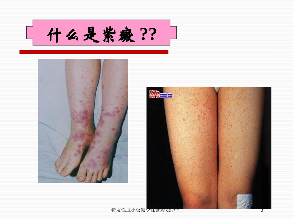 特发性血小板减少性紫癜的护理培训课件.pptx_第3页