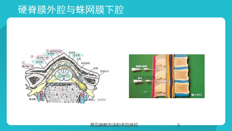 常见麻醉方法和术后体位课件.pptx_第3页