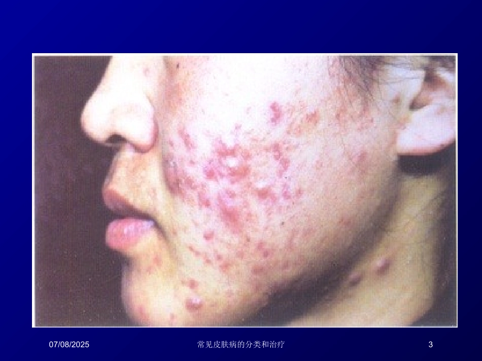 常见皮肤病的分类和治疗课件.pptx_第3页