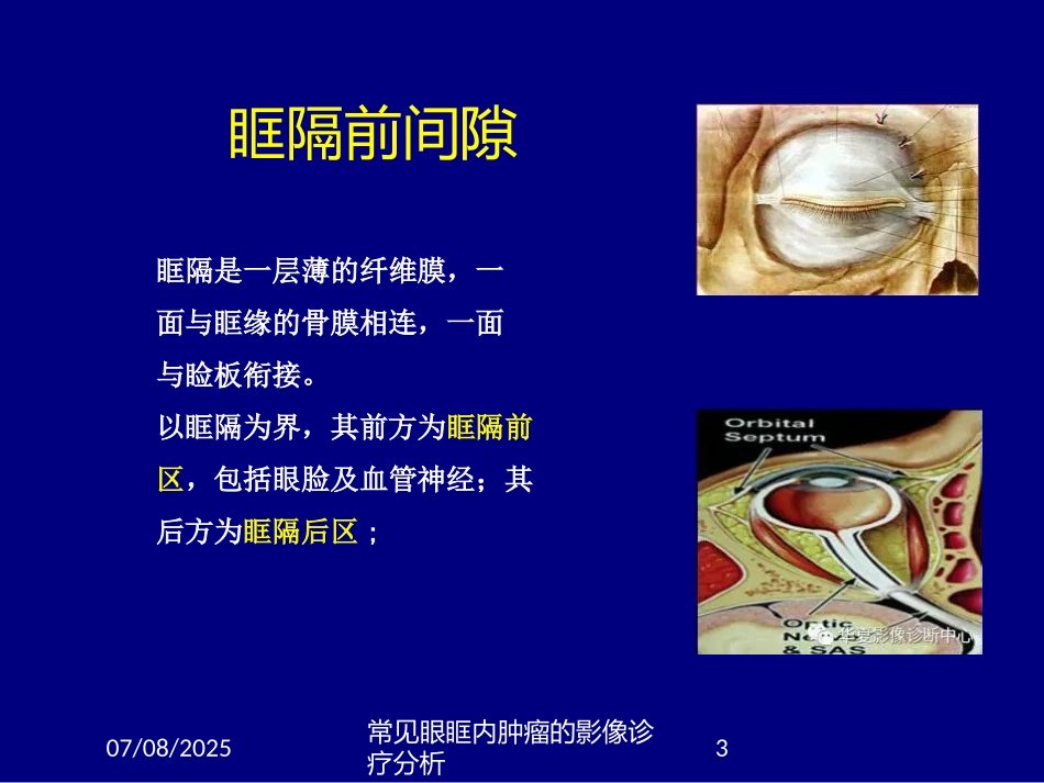 常见眼眶内肿瘤的影像诊疗分析课件.pptx_第3页