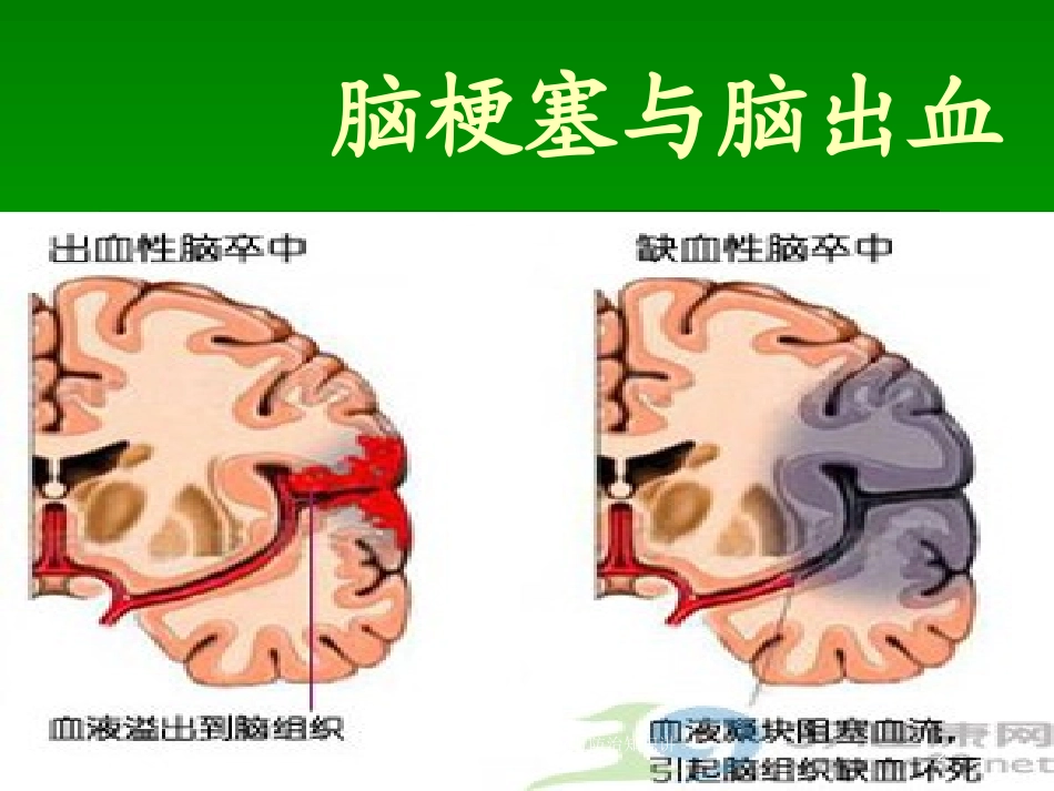 村乡卫生院高血压性脑出血防治知识讲座培训课件.pptx_第2页
