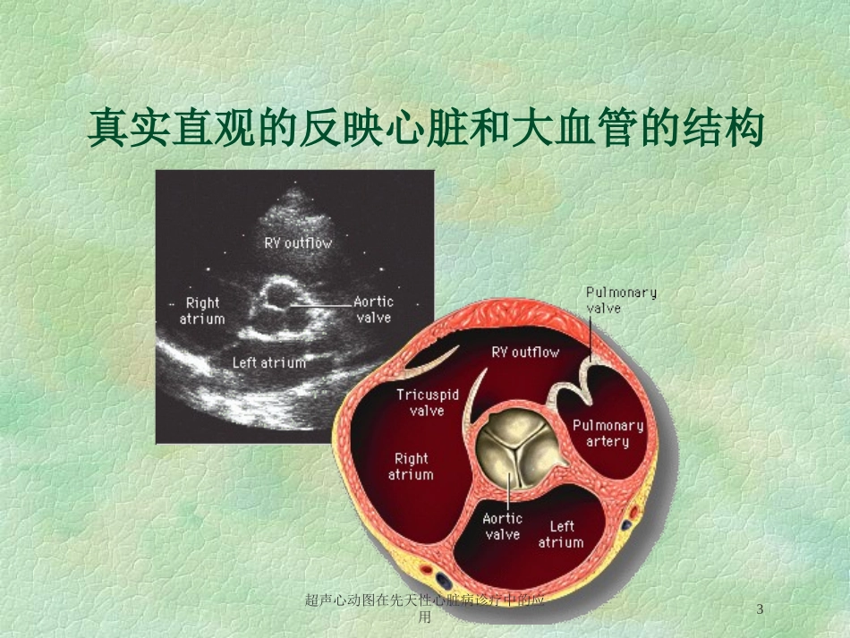 超声心动图在先天性心脏病诊疗中的应用培训课件.pptx_第3页