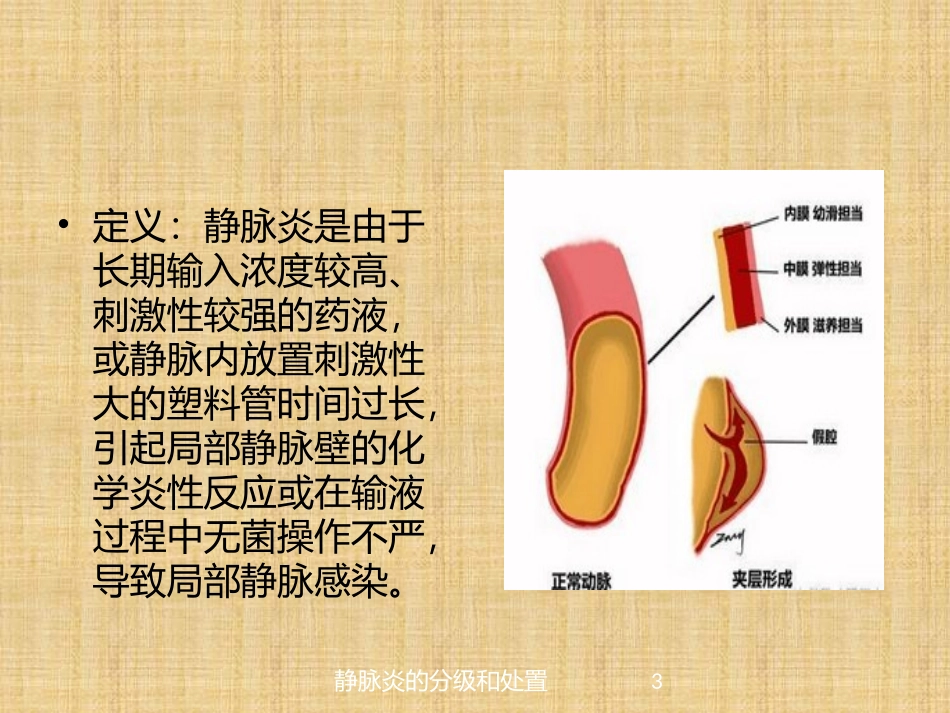 静脉炎的分级和处置培训课件.pptx_第3页