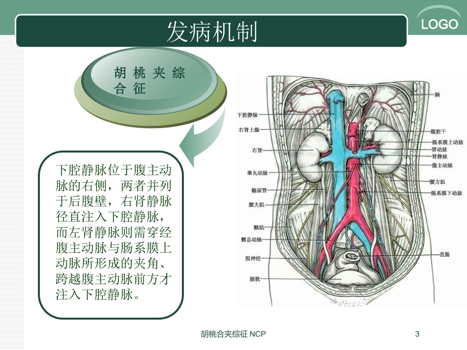 胡桃合夹综征NCP培训课件.pptx_第3页