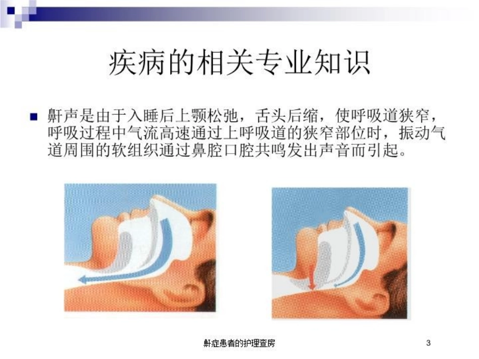 鼾症患者的护理查房培训课件.pptx_第3页