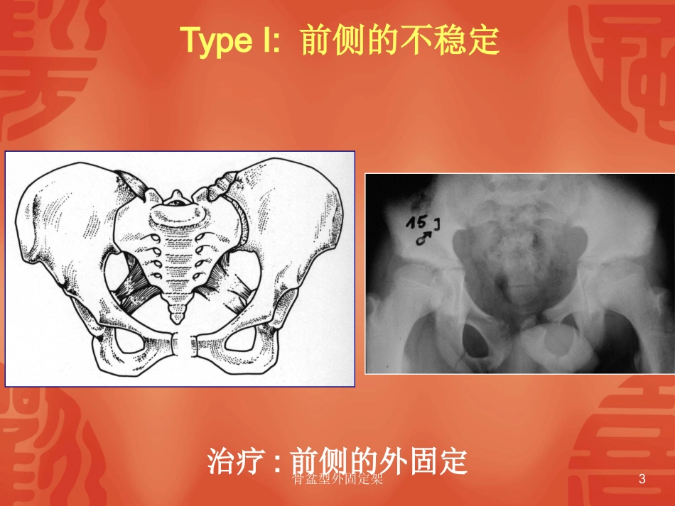 骨盆型外固定架培训课件.pptx_第3页